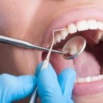 چرا برخی بیماران پس از استفاده از التراسونیک دندانپزشکی دچار حساسیت دندانی می‌شوند؟ - ژین دنتال